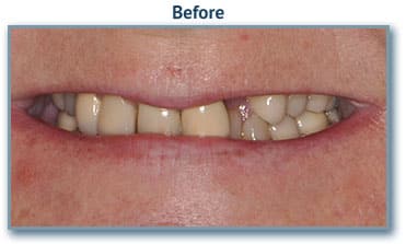Missing Teeth implants
