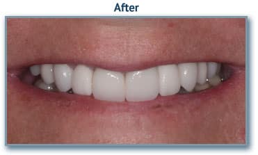 After dental implants
