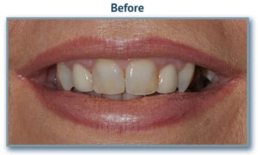 Teeth implant