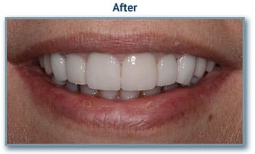 After teeth whitening