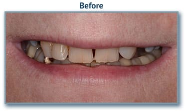 Dental implant