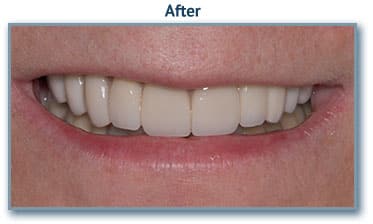 After Teeth Replacement
