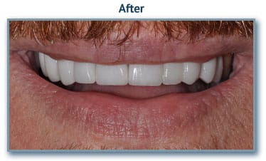 After Dental implants