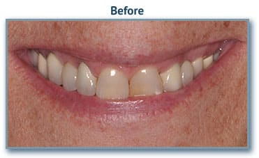 teeth whitening