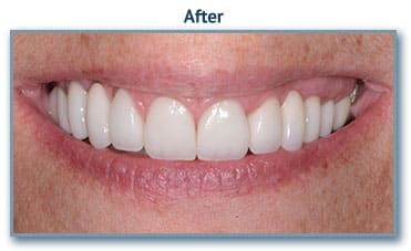 teeth whitening
