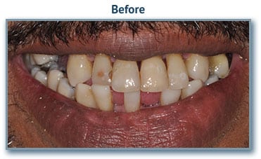 Before teeth implants