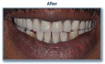 teeth whitening