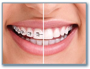 teeth whitening teeth whitening