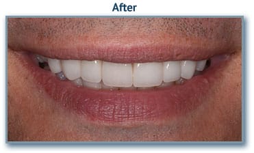 smile3b denture implants