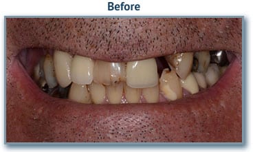 Before dental implants