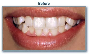 Smile makeover- dentist buford, ga