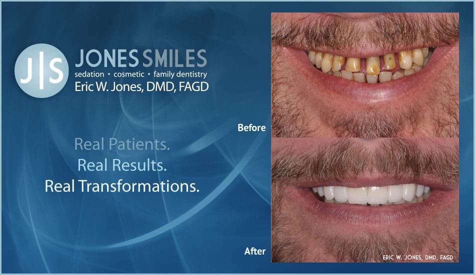 <strong>Chipped, Worn or Mismatched Teeth</strong>