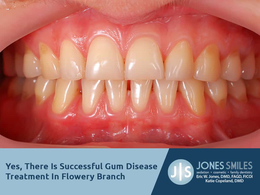 Yes, there is successful gum disease treatment in buford