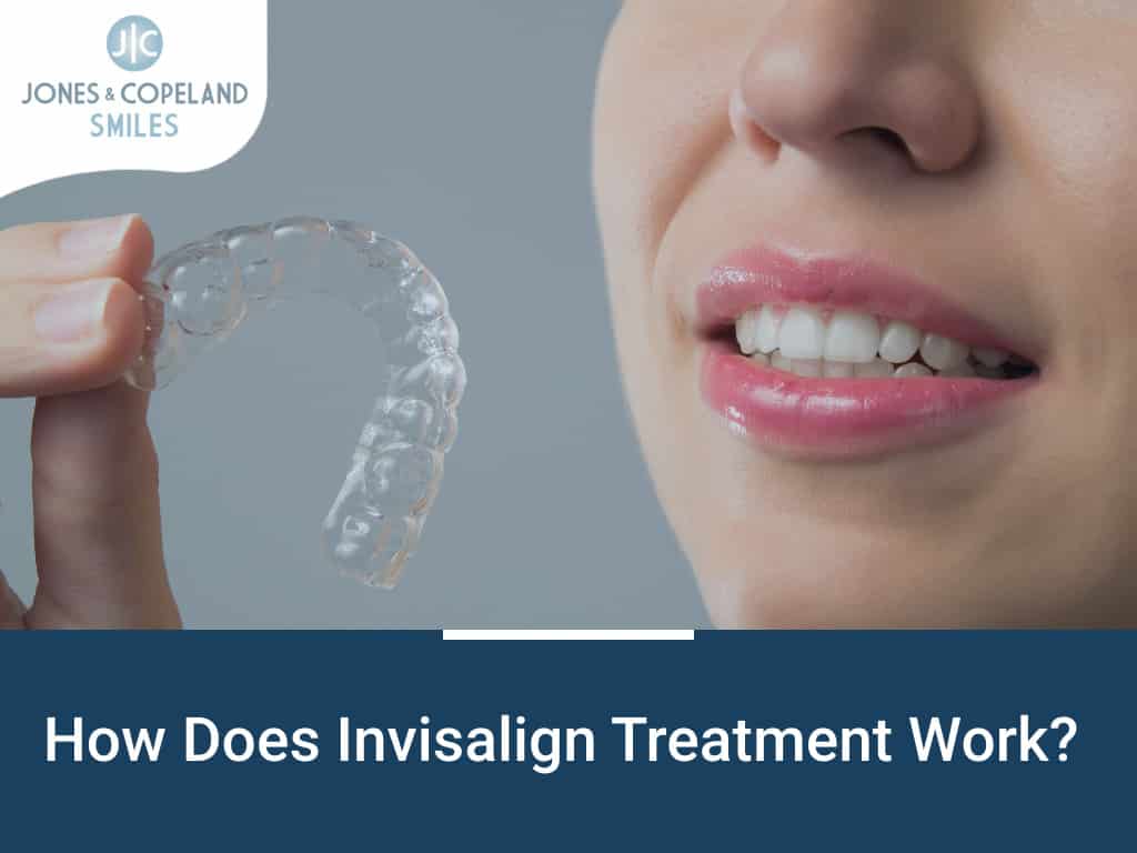 How Does Invisalign Work Better Than Braces?