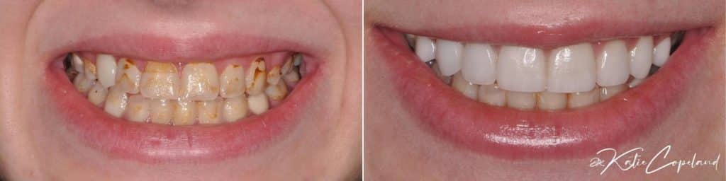 before and after cosmetic teeth whitening