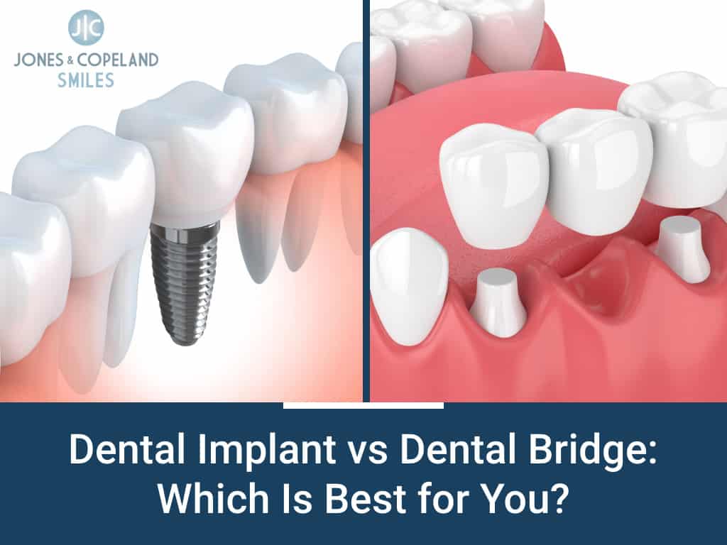 Dental bridge vs implant which is best for you
