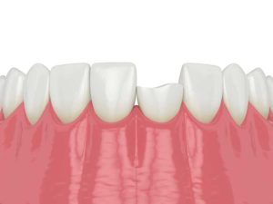 chipped tooth illustration