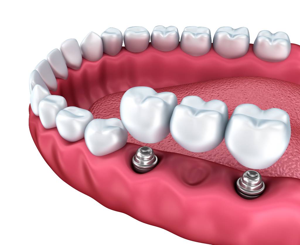 Endosteal dental implant