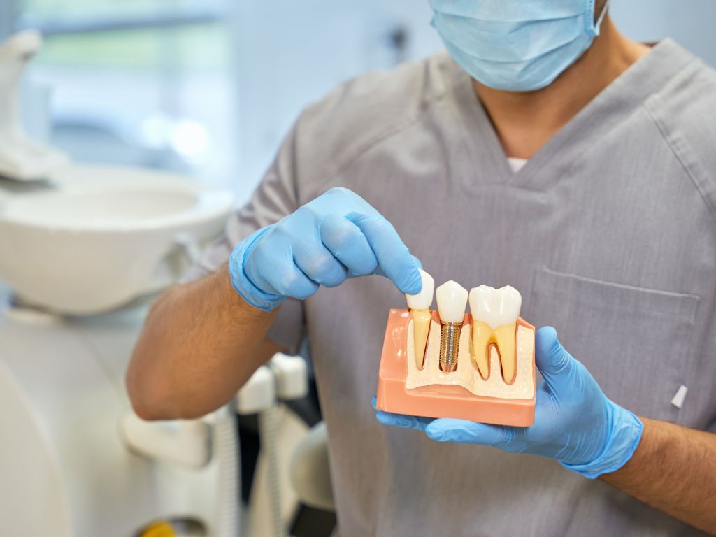 what exactly are dental implants